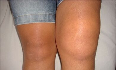 Les causes de l'arthrose de l'articulation du genou